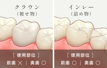クラウン（被せ物）：[使用部位]前歯×|奥歯○/インレー（詰め物）：[使用部位]前歯○|奥歯○