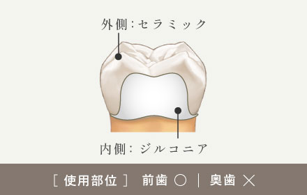 外側：セラミック/内側：ジルコニア　[使用部位]前歯○|奥歯×