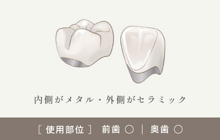 内側がメタル・外側がセラミック 　[使用部位]前歯○|奥歯○