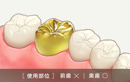 内側がメタル・外側がセラミック 　[使用部位]前歯×|奥歯○