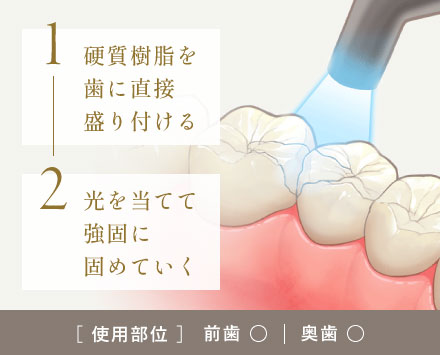 1:硬質樹脂を歯に直接盛り付ける 2:光を当てて強固に固めていく [使用部位]前歯○|奥歯○